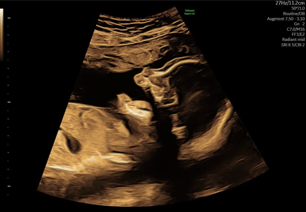 Sen tryghedsscanning med 3D ultralyd af foster fra Praksis Jordemoder viser babyens ansigtsprofil