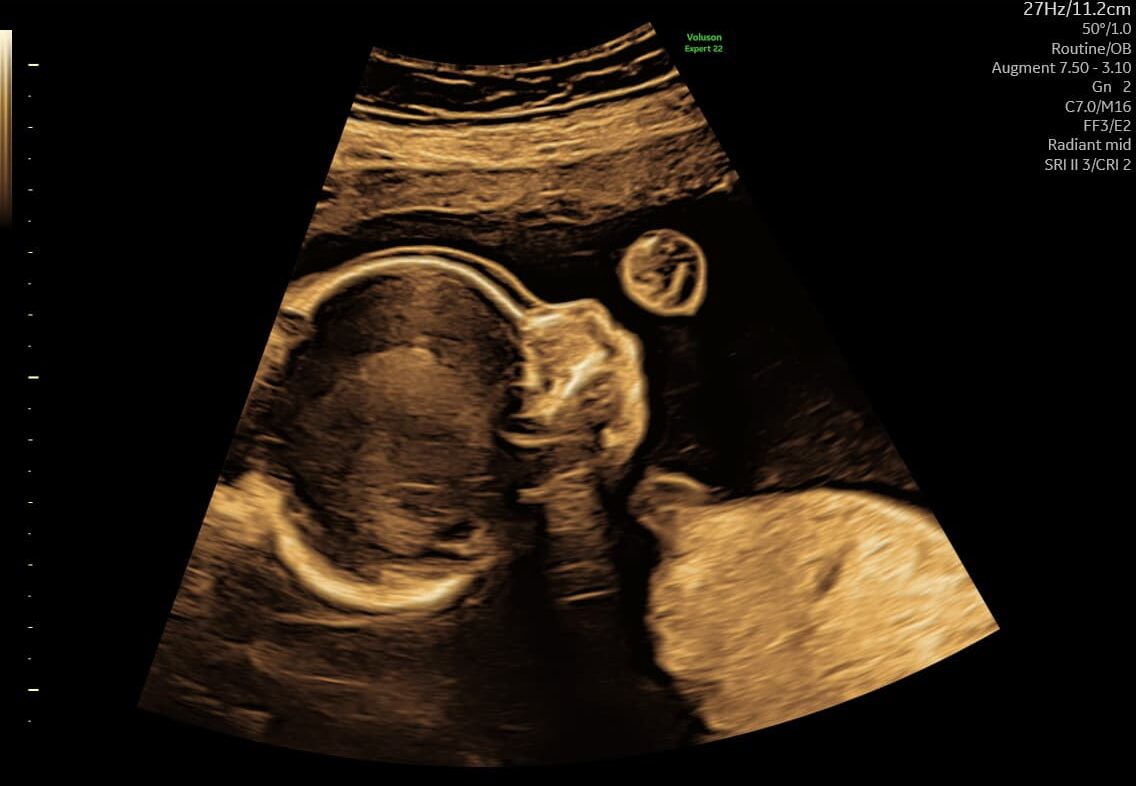 210_4-e1735733039200 Ultralydsbillede af baby der vises ved tryghedsscanning hos praksisjordemoder.dk