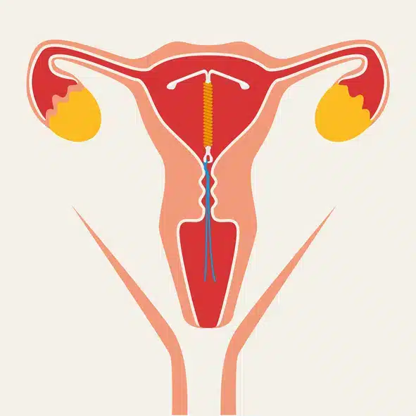 Illustration af en kobberspiral korrekt placeret i livmoderen