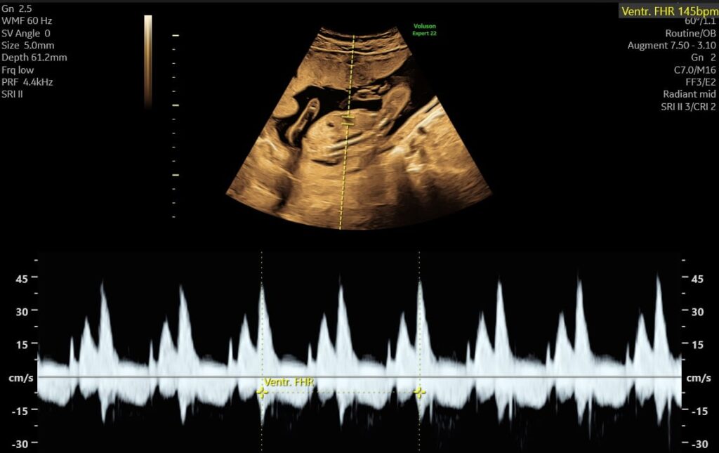 S-170_1-e1735733065695-1024x645 Ultralydsscanning af foster med måling af hjertefrekvens vist på sort skærm