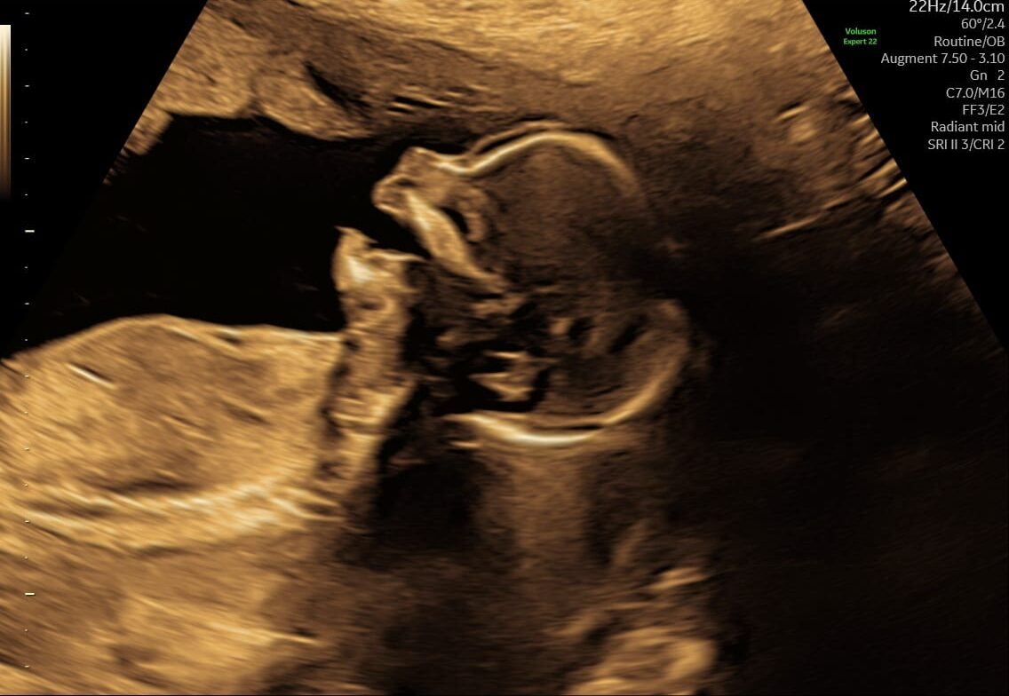 S-170_16-1-e1735733109131 Ultralydsbillede af baby til tryghedsscanning hos Praksis Jordemoder