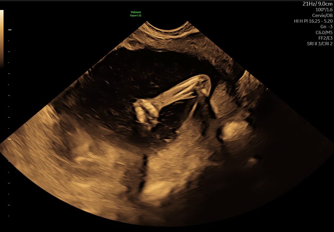 S-170_18-e1735733100844 Ultralydsscanning der viser en baby i livmoderen under en tryghedsscanning hos Praksis Jordemoder