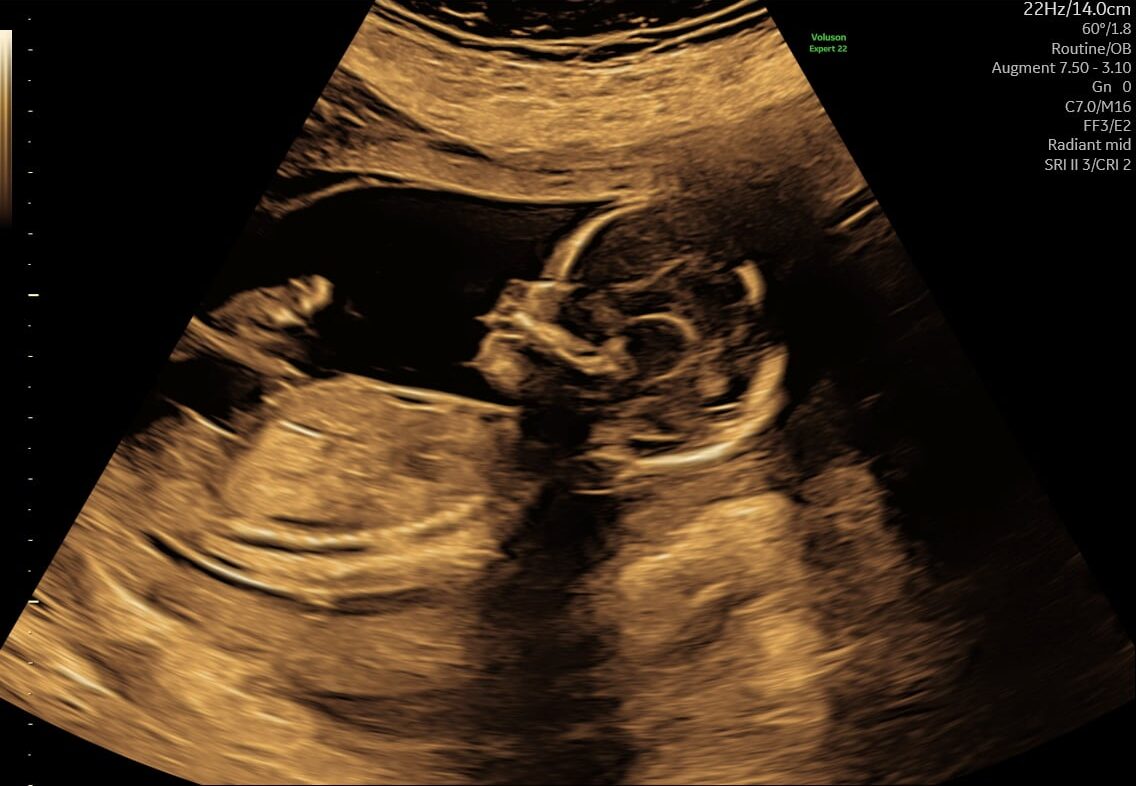 S-170_6-e1735733074785 Ultralydsscanning af baby til tryghedsscanning hos Praksis Jordemoder