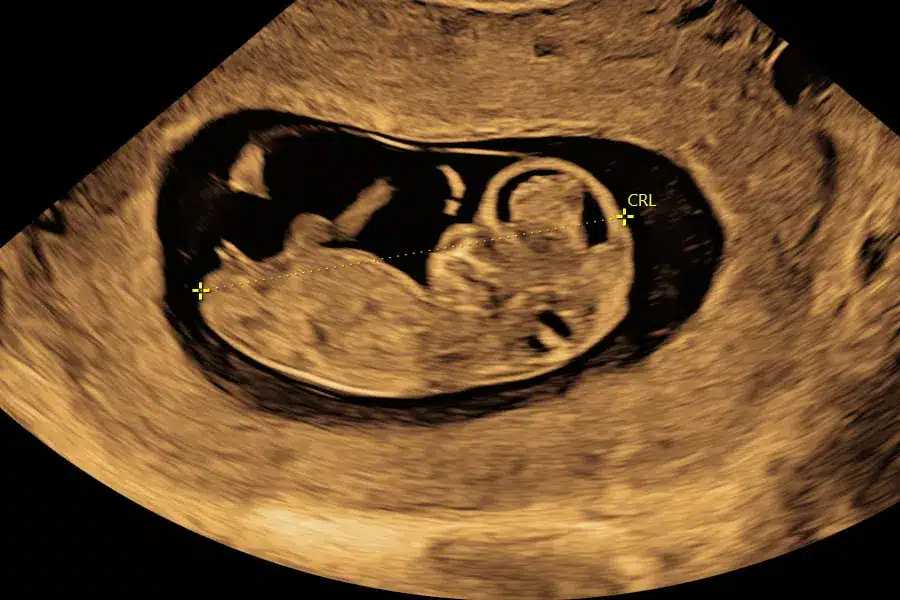Ultralydsscanning af foster tidlig graviditet på Praksisjordemoder.dk viser babyens udvikling og måling af CRL