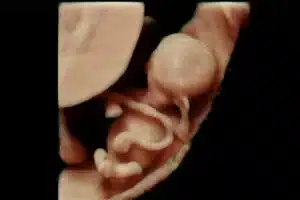 3D scanning af foster i livmoderen, tidlig graviditetsscanning på Praksisjordemoder.dk