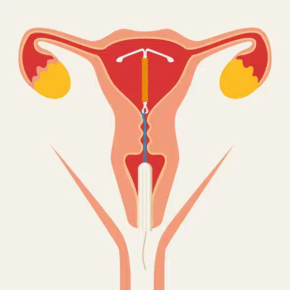 Spiral-placering.jpg Illustration af en spiral placeret i livmoderen