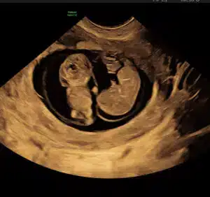 3D-ultralydsscanning af et foster i livmoderen under en tidlig graviditet.