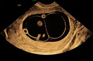 Ultralydsbillede af tvillinger i livmoderen hos Praksisjordemoder.dk under en tidlig graviditetsscanning