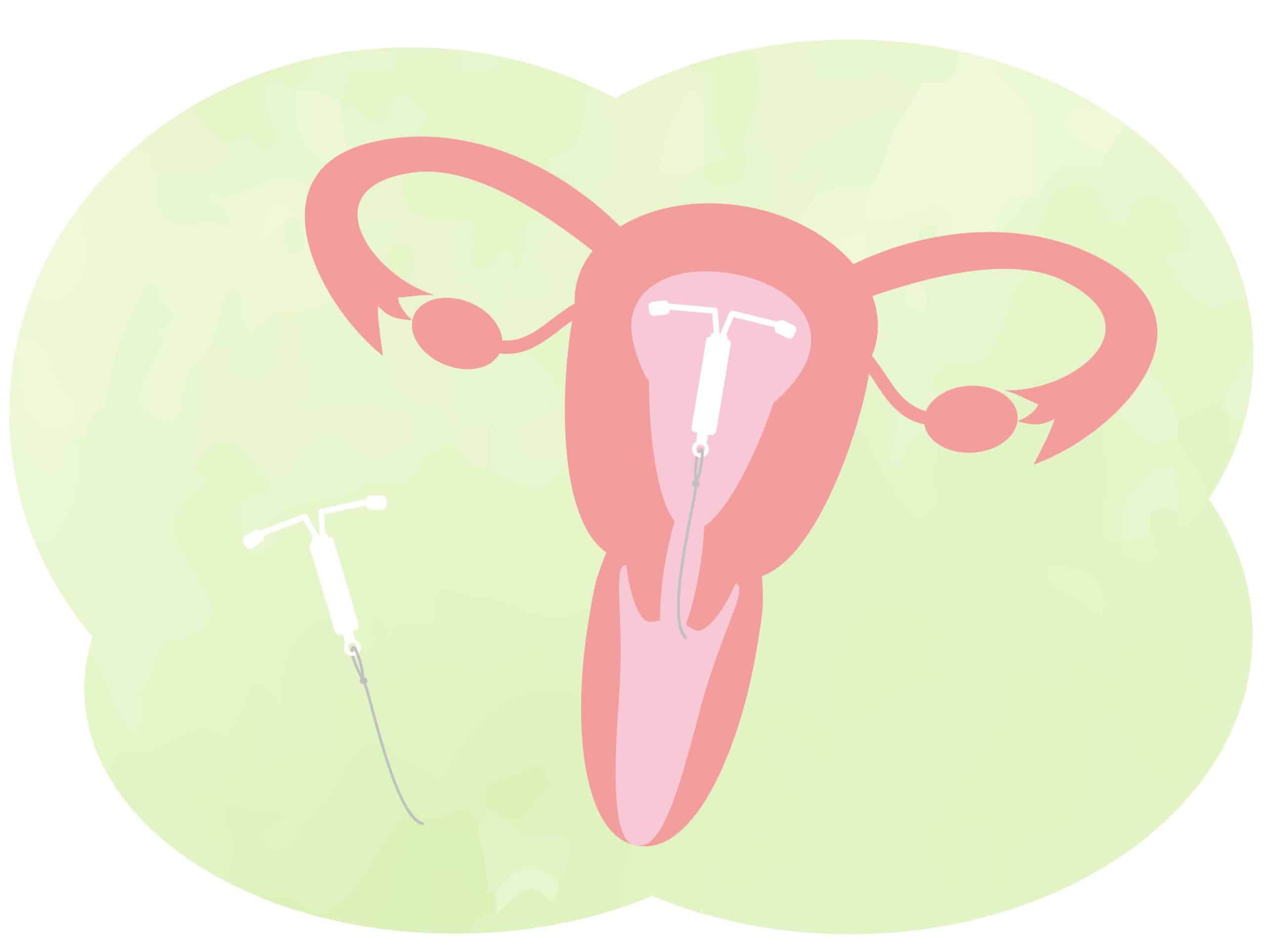 This is an illustration of an IUD (intrauterine device). Illustration af livmoder med spiral (IUD) og en spiral vist separat på grøn baggrund