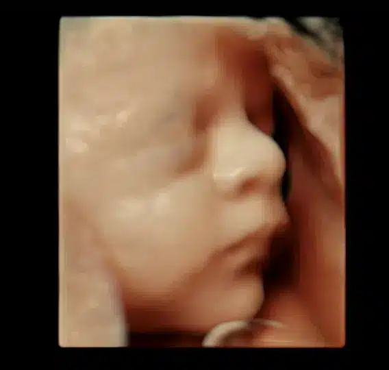3D-scanning af baby uge 32 i profil
