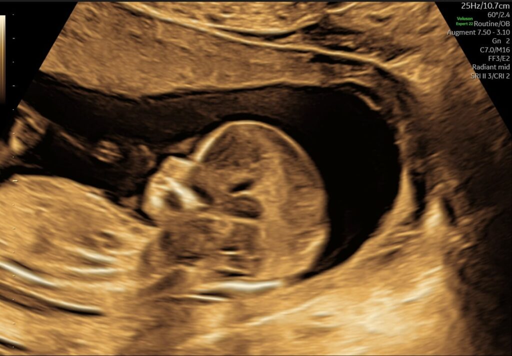 s-145-koensscanning_10-e1735731115409-1024x712 Ultralydsbillede af baby til kønsscanning hos Praksis Jordemoder