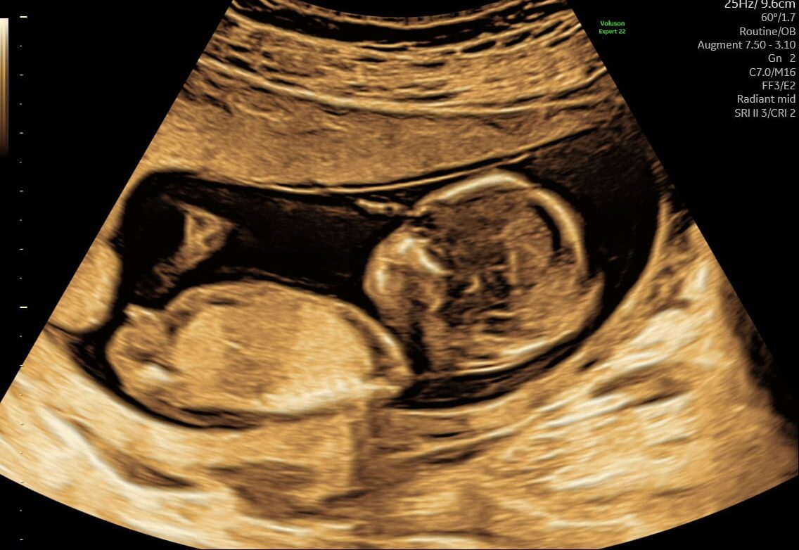 s-145-koensscanning_4-e1735731099826 Ultralydsscanning af baby i uge 14 ved kønsscanning hos praksisjordemoder i København og Hillerød