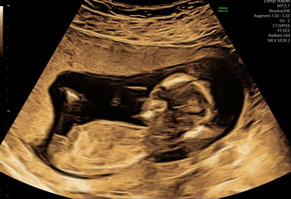 s-145-koensscanning_6-e1735731021651 Billede af en baby scannet ved en kønsscanning hos Praksisjordemoder i København eller Hillerød
