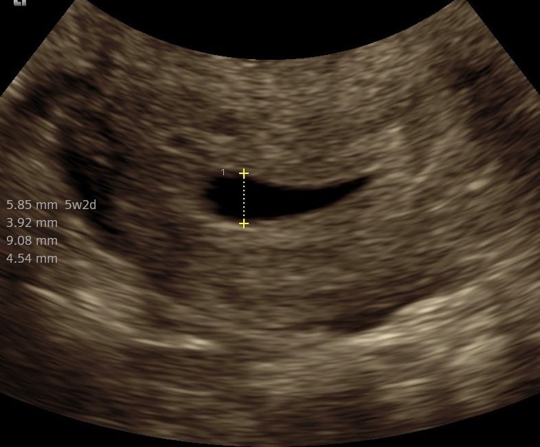 Tryghedsscanning uge 5+2