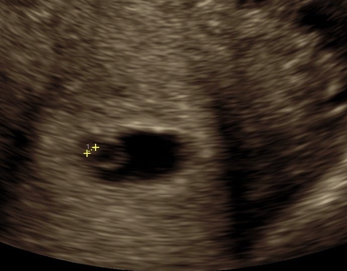 Tryghedsscanning uge 5+4