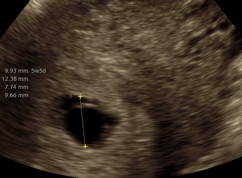 Tryghedsscanning uge 5+5