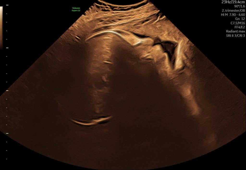 Ultralyd uge 37 – vurdering af barnets lejring i slutningen af graviditeten