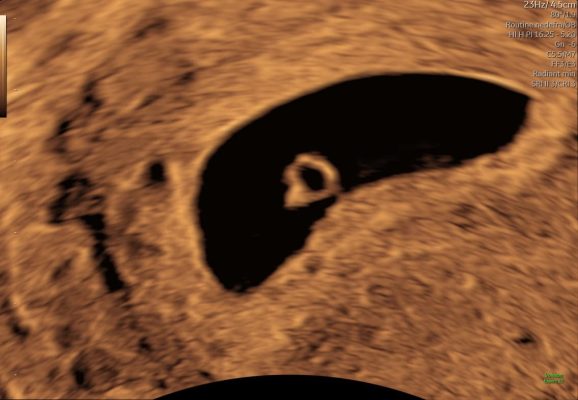 Ultralydsscanning uge 5 i tidlig graviditet – graviditetssæk i livmoderen