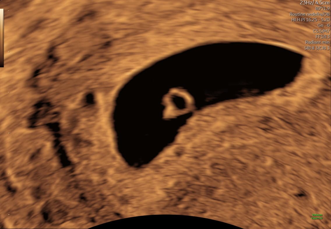 Ultralydsscanning uge 5 i tidlig graviditet – graviditetssæk i livmoderen