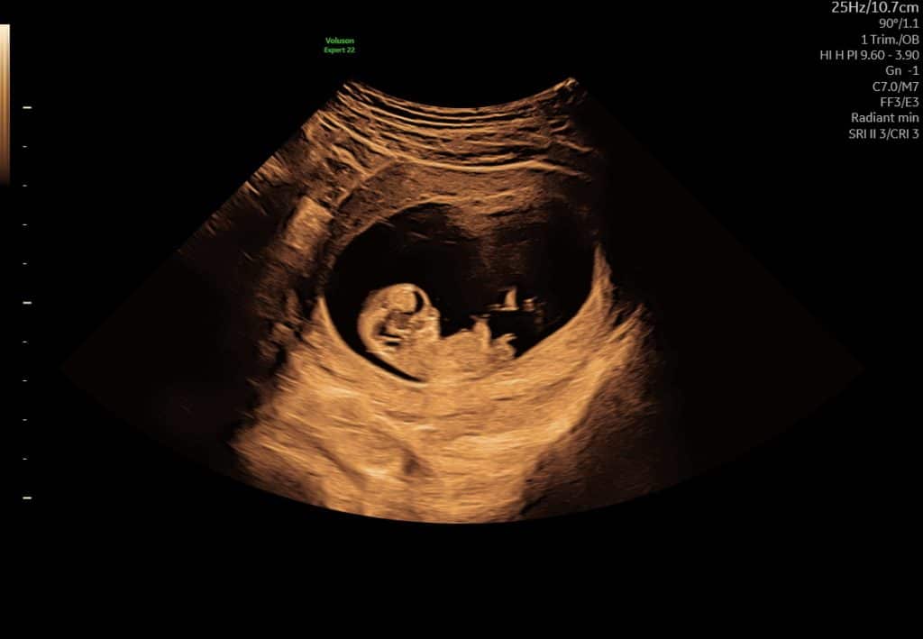 Ultralyd i uge 10 – fosterets hoved og krop kan skelnes