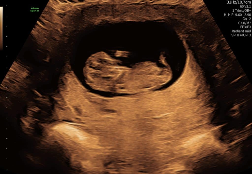 Graviditetsscanning uge 11 – fosterets bevægelser og kropsform