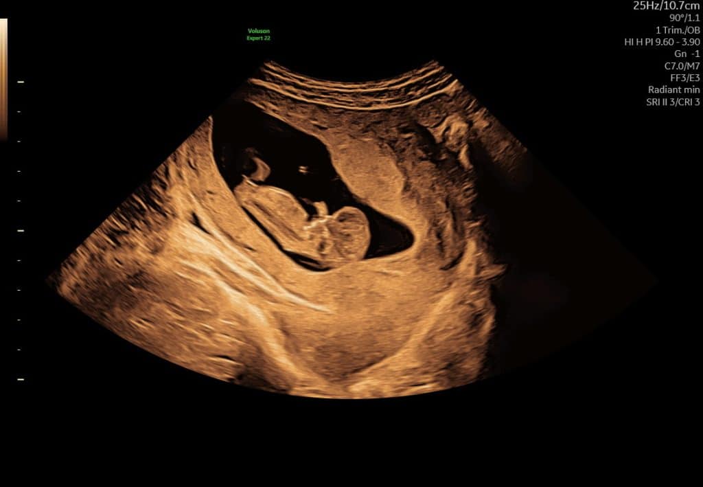 Ultralyd uge 11 med synlige arme og ben