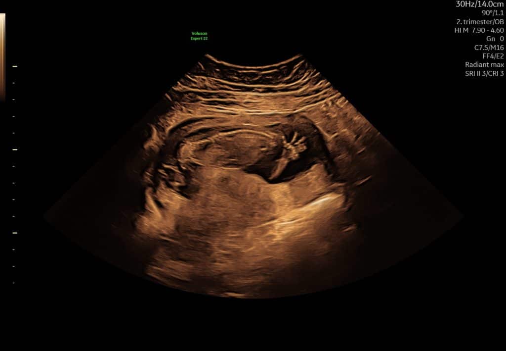 Ultralydsscanning uge 124– foster med fingre