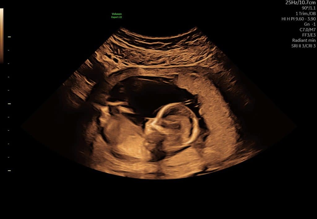 Ultralyd i uge 14 som viser fosteret set i profil