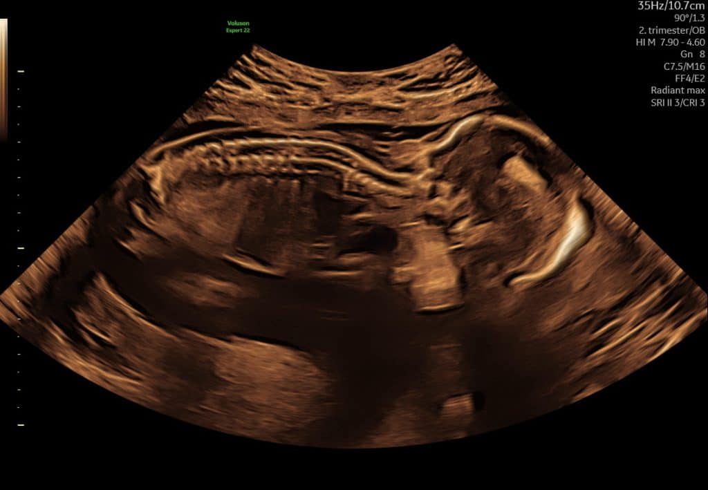 Ultralyd i uge 18 som viser barnets rygsøjle set i længdesnit