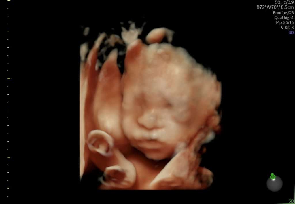 Ultralydsscanning i sen graviditet – fosterets ansigt delvist synligt