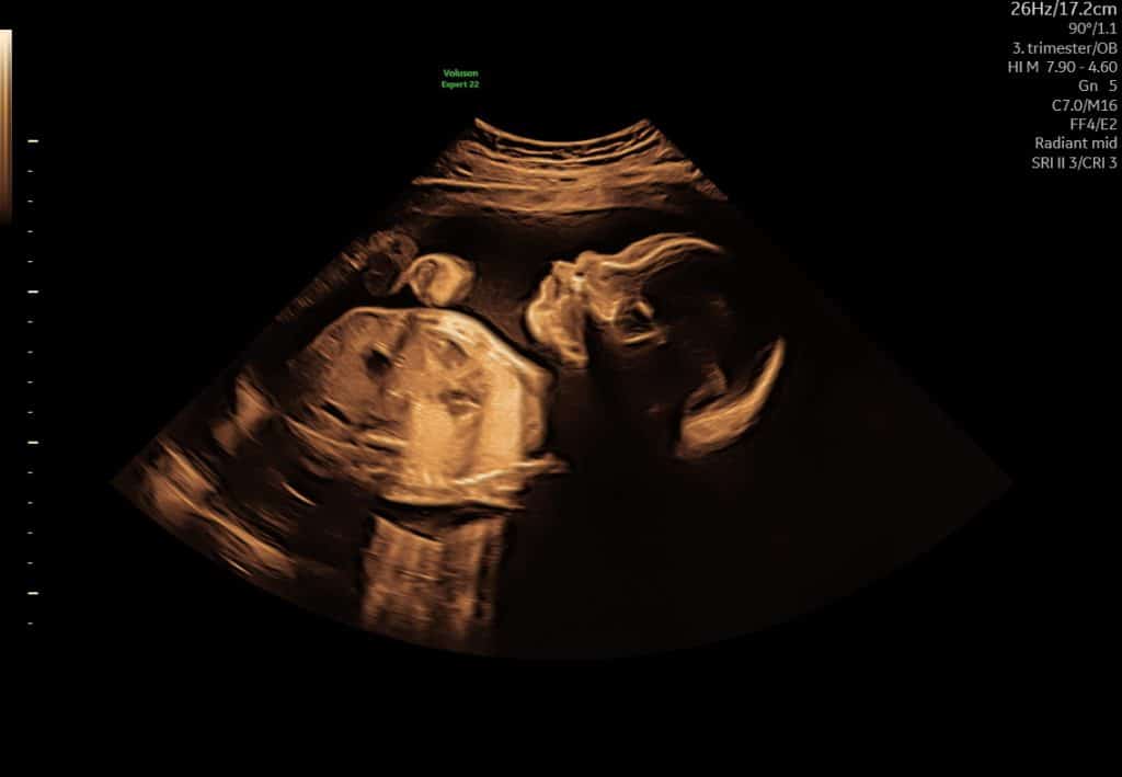 Tilvækstscanning – fostervægt og vækstvurdering