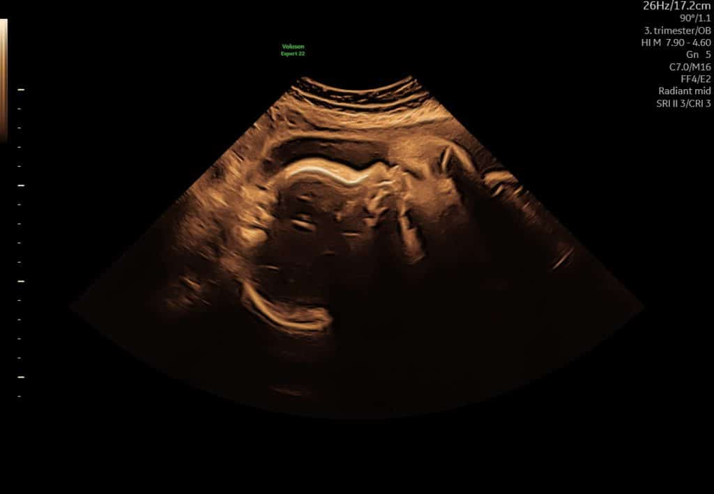 Ultralydsscanning uge 30 – fosterets ansigt i profil