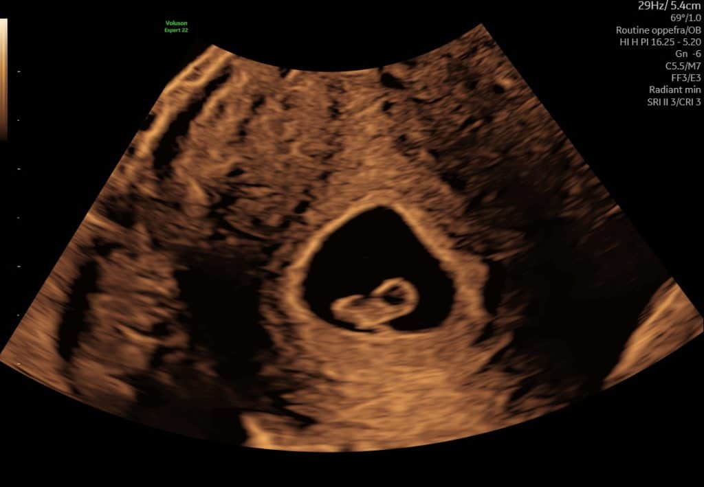 Ultralydsscanning uge 6 med gestationssæk og begyndende fosteranlæg
