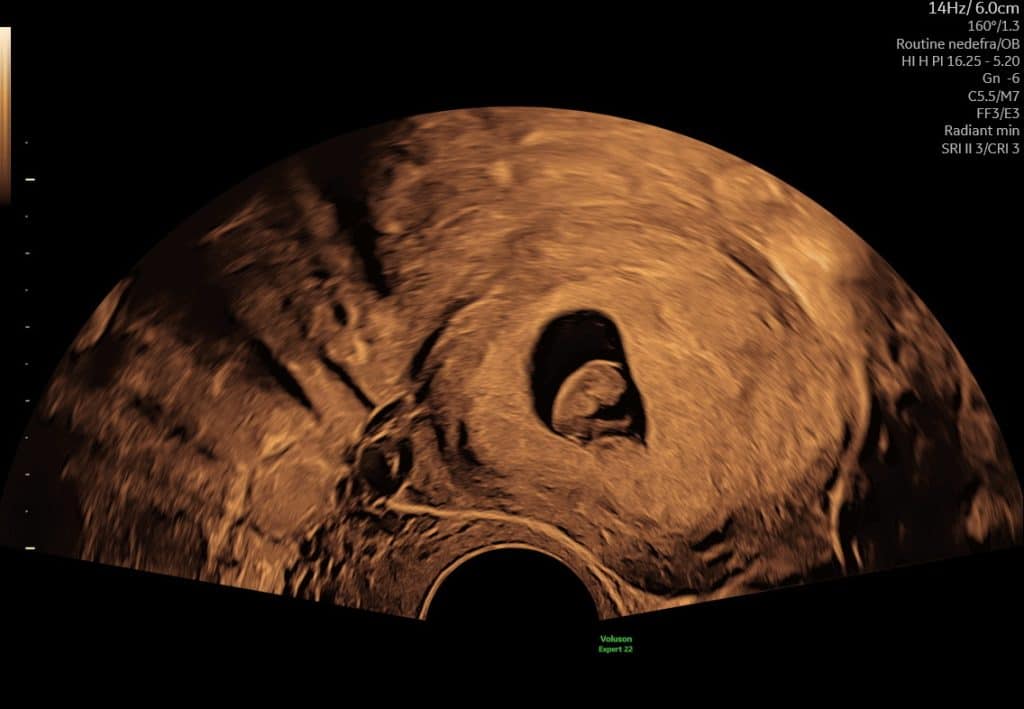 Ultralydsscanning uge 7 med tydeligt foster og synligt hjerteblink