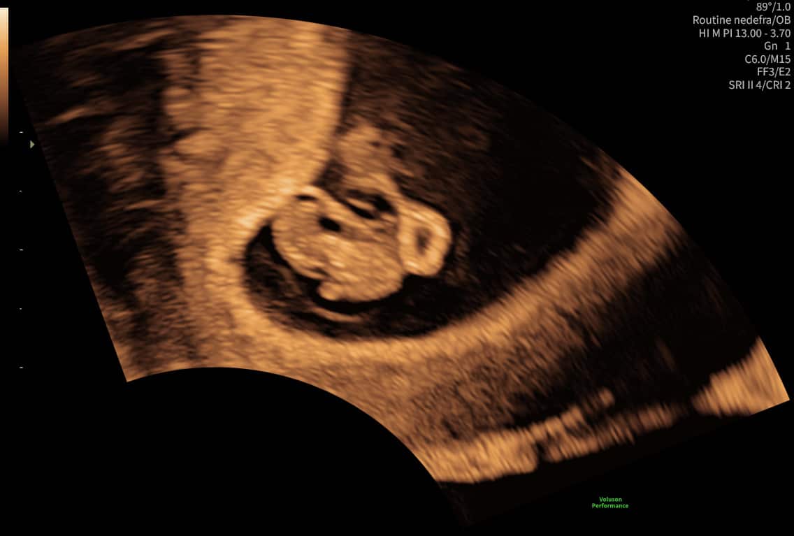 Tidlig scanning fra uge 5