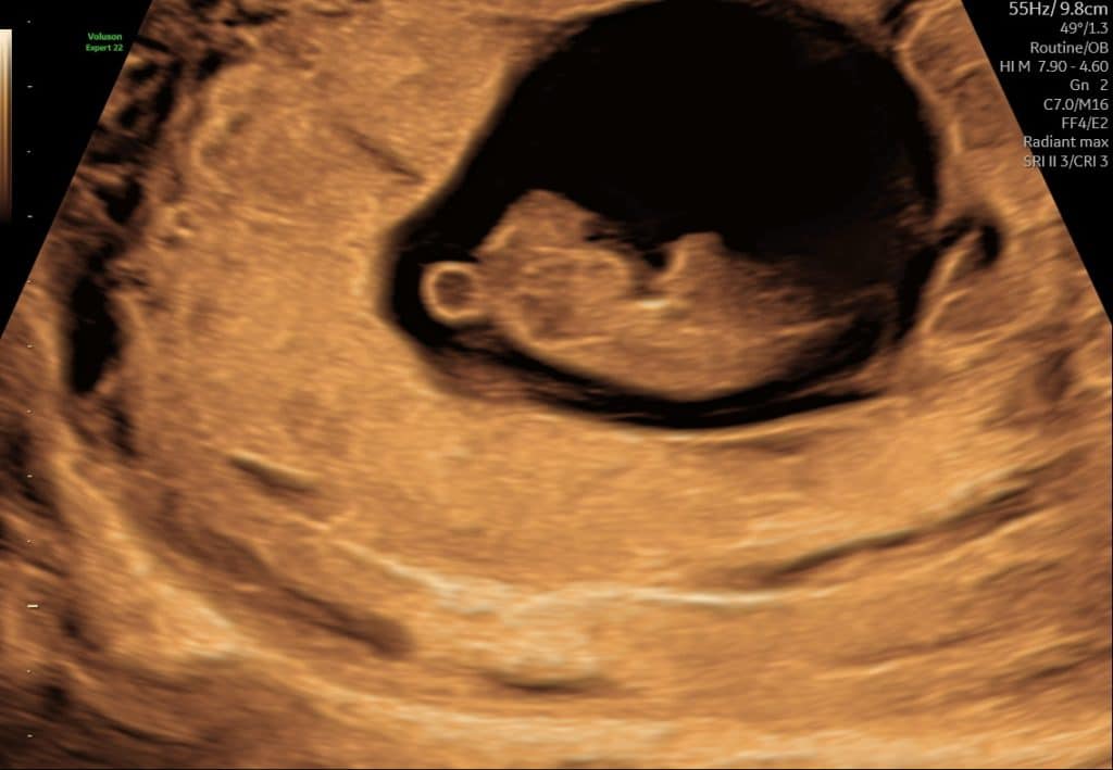 Ultralydsscanning uge 9 – tydeligere foster med bevægelse