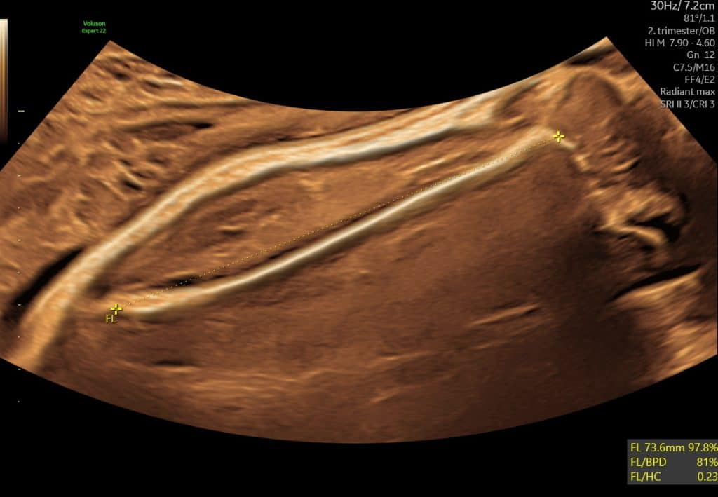 Ultralydsscanning i uge 37 med fokus på om barnet ligger med hovedet her femur