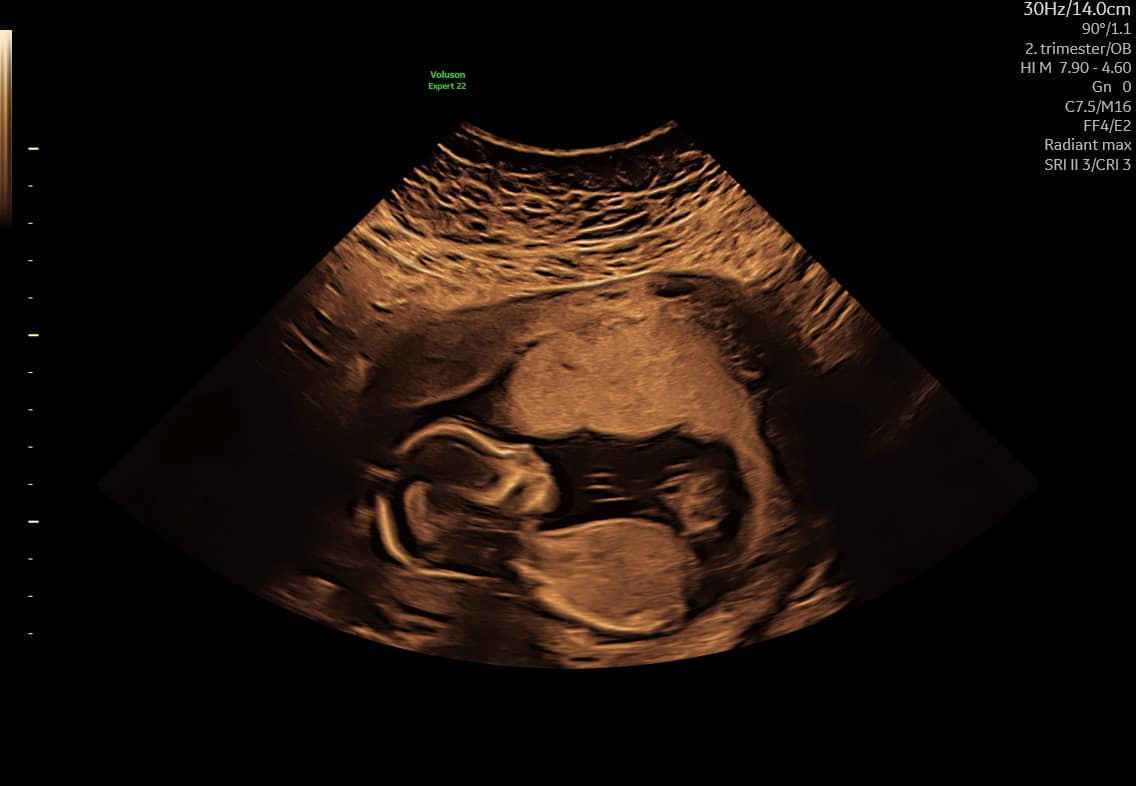 Tryghedsscanning – 2D-ultralyd af foster i 2. trimester