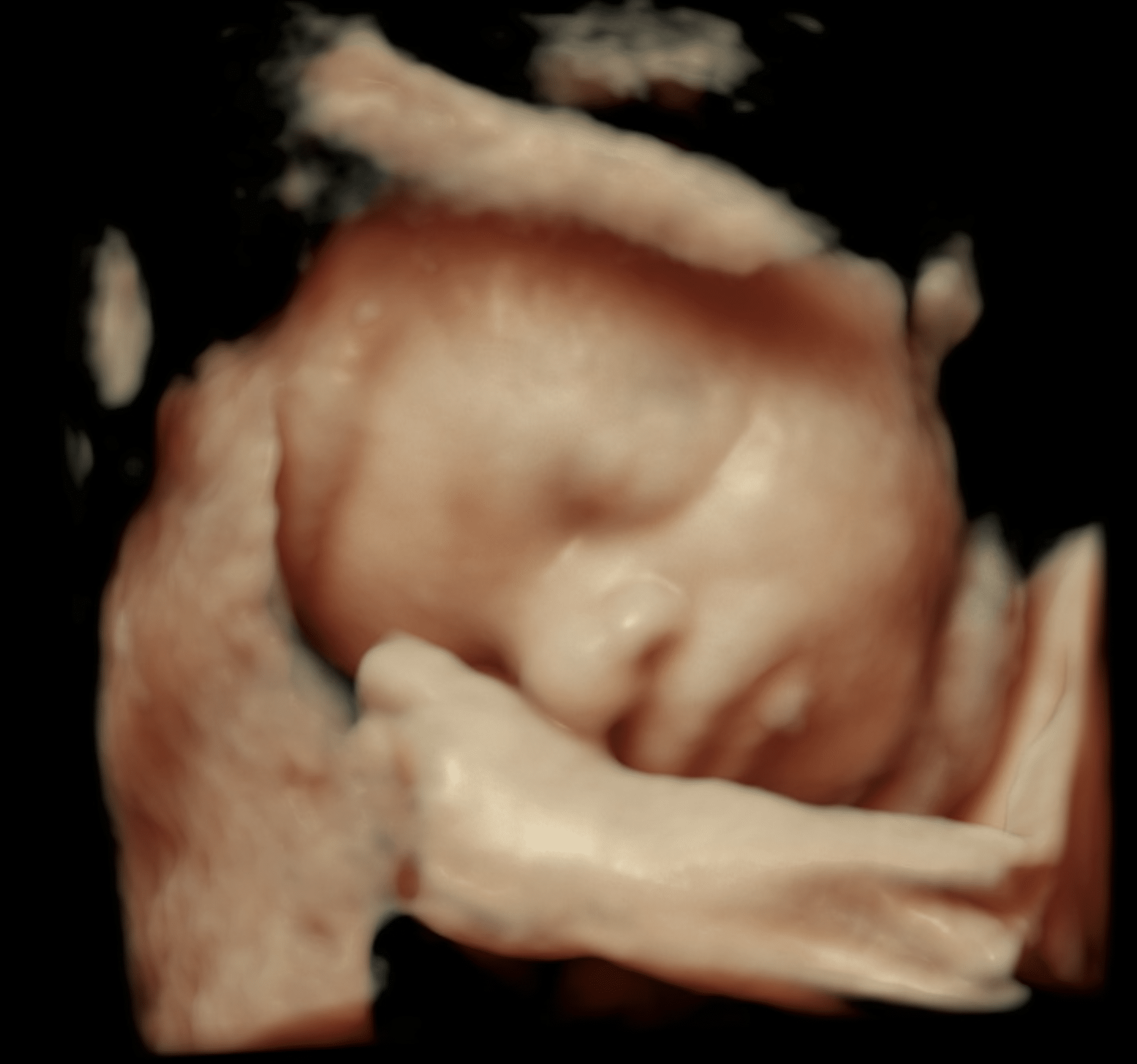 3D-scanning af baby uge 28 med hånd foran ansigtet