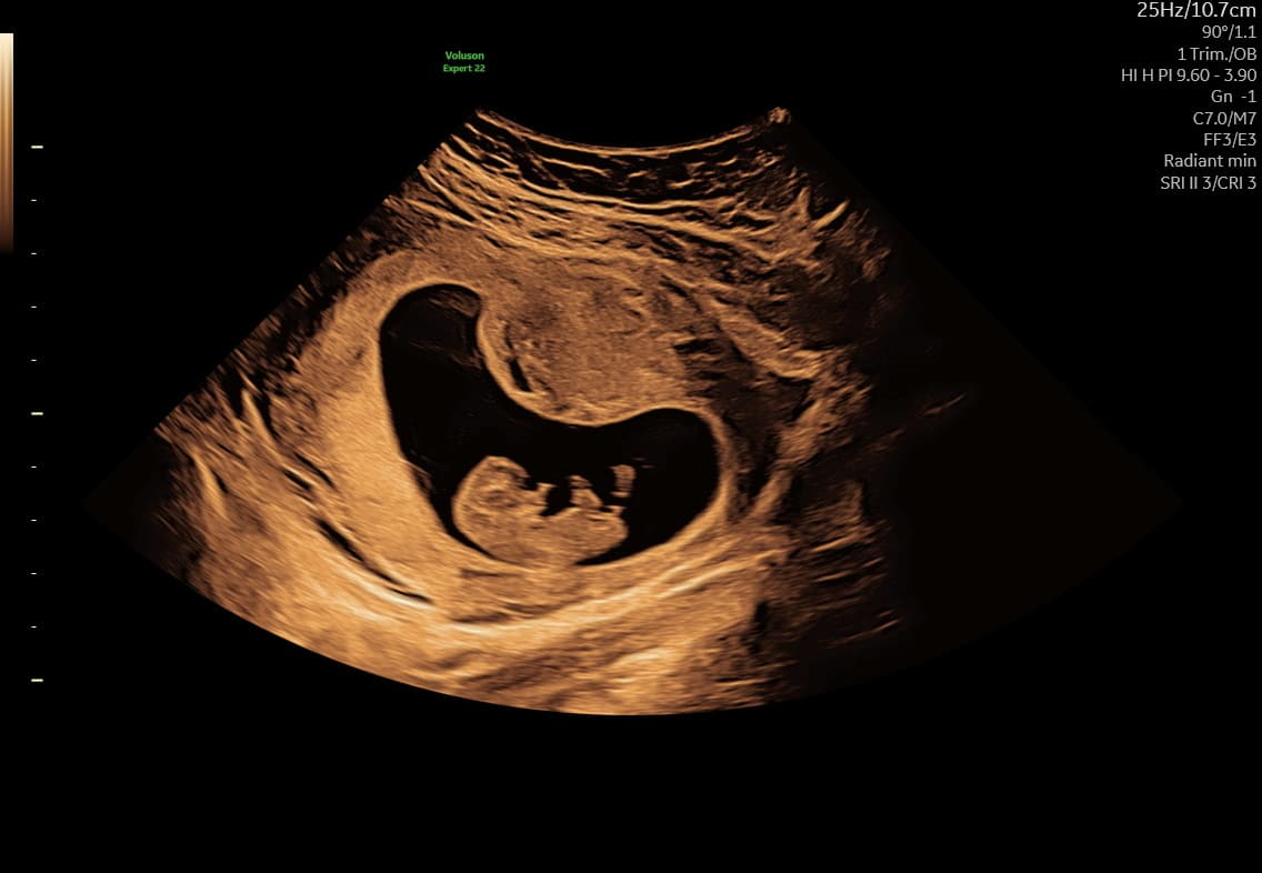 Tidlig scanning i uge 10+1 — foster med tydeligt hoved, krop, arme og ben