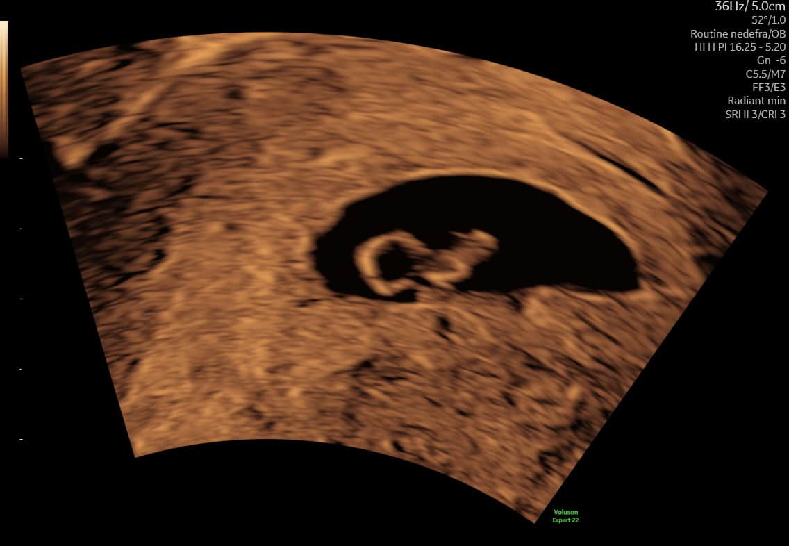 Tidlig ultralydsscanning i uge 6+1 — foster på ca. 4 mm med synligt hjerteslag