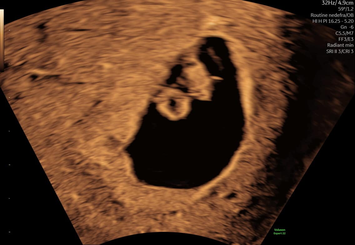 Tidlig graviditetsscanning i uge 7+1 — foster med hoved og krop adskilt