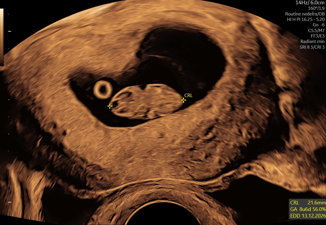 Tidlig scanning i uge 8+6 — foster med begyndende lemmeknopper