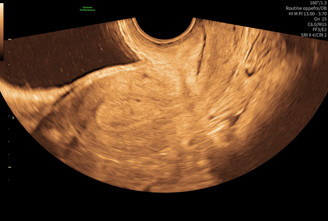 Vaginal ultralydsscanning af livmoderen ved fertilitetstjek – livmoderslimhinden vurderes