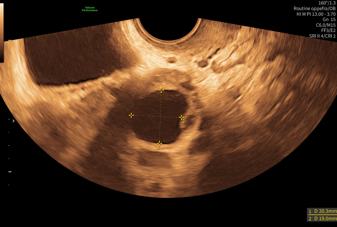 Vaginal ultralydsscanning af æggestok ved fertilitetstjek – follikel måles til 20 mm